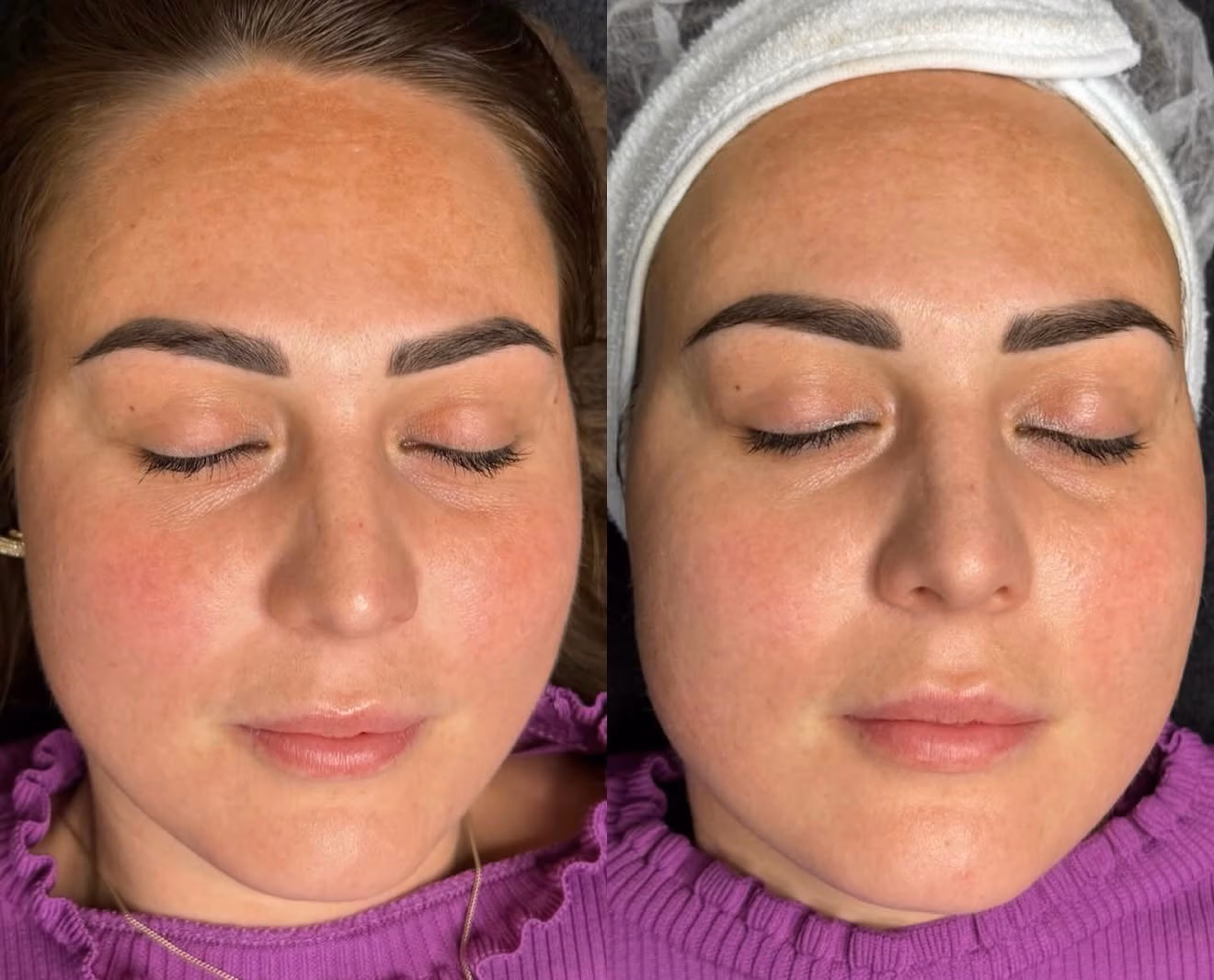 Resultaatfoto van huid bij Sparklezz Beauty